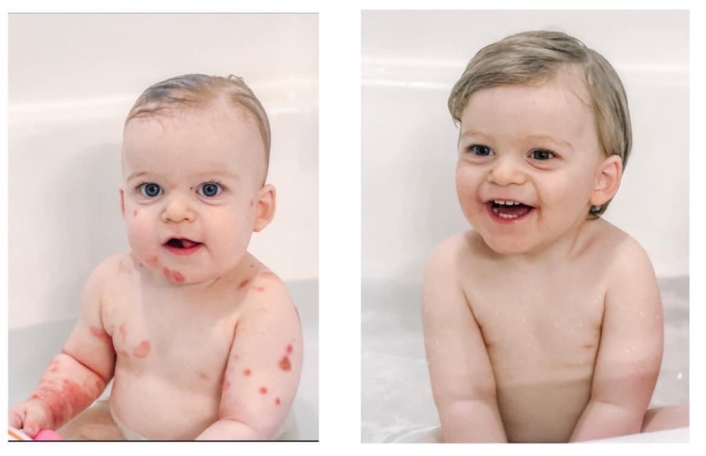 Before and After pictures of "Owen" who no longer suffers with eczema