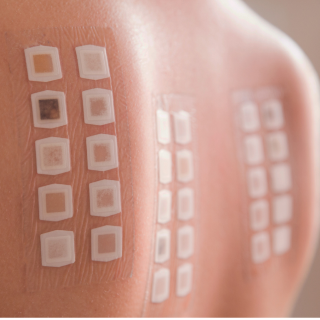 Allergy testing can be done via Skin Prick Test or Blood Testing