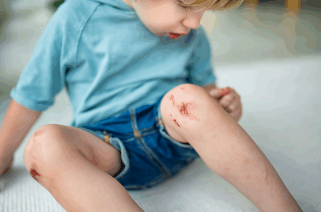 Kid with scraped knee - summer first aid kit Briotech