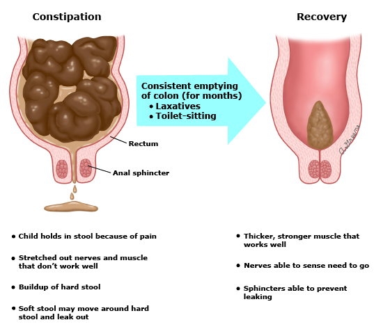 how to help my constipated child diagram showing colon