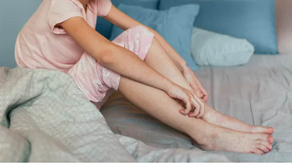eczema keeps your child up at night