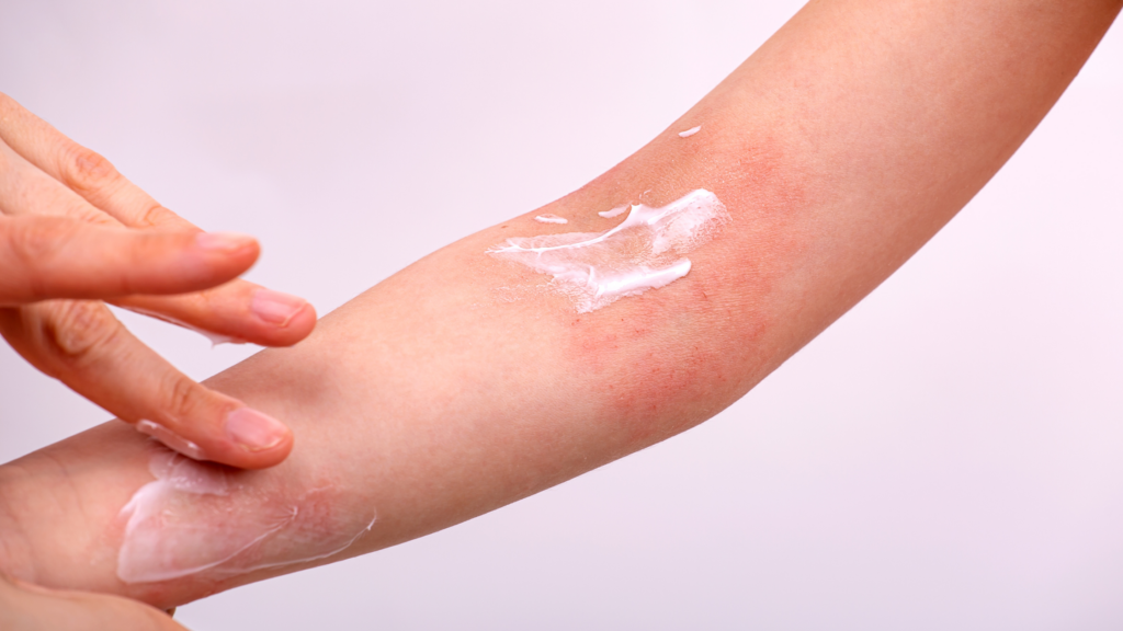 Dr. Aron Method for eczema